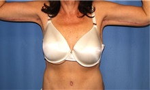 Arm Lift After Photo by Siamak Agha, MD PhD FACS; Newport Beach, CA - Case 44117