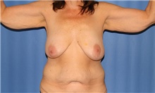 Arm Lift Before Photo by Siamak Agha, MD PhD FACS; Newport Beach, CA - Case 44117