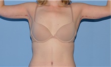 Body Contouring After Photo by Siamak Agha, MD PhD FACS; Newport Beach, CA - Case 44122