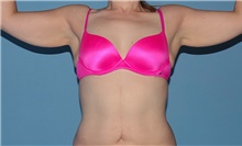 Body Contouring Before Photo by Siamak Agha, MD PhD FACS; Newport Beach, CA - Case 44122