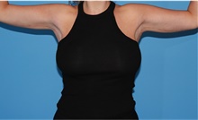 Arm Lift After Photo by Siamak Agha, MD PhD FACS; Newport Beach, CA - Case 44133