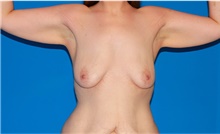Arm Lift Before Photo by Siamak Agha, MD PhD FACS; Newport Beach, CA - Case 44133