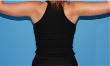 Arm Lift After Photo by Siamak Agha, MD PhD FACS; Newport Beach, CA - Case 44133