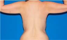 Arm Lift Before Photo by Siamak Agha, MD PhD FACS; Newport Beach, CA - Case 44133