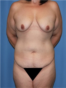 Body Contouring Before Photo by Siamak Agha, MD PhD FACS; Newport Beach, CA - Case 44165