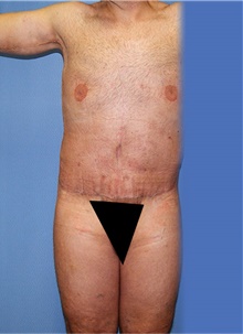 Body Lift After Photo by Siamak Agha, MD PhD FACS; Newport Beach, CA - Case 44314