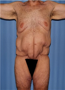 Body Lift Before Photo by Siamak Agha, MD PhD FACS; Newport Beach, CA - Case 44314