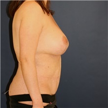 Mommy Makeover After Photo by Steve Laverson, MD, FACS; Rancho Santa Fe, CA - Case 44346