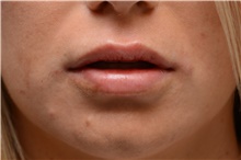 Lip Augmentation/Enhancement After Photo by Carlos Rivera-Serrano, MD; Miami Beach, FL - Case 44609