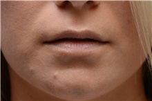 Lip Augmentation/Enhancement Before Photo by Carlos Rivera-Serrano, MD; Miami Beach, FL - Case 44609