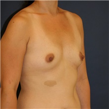 Breast Augmentation Before Photo by Steve Laverson, MD, FACS; Rancho Santa Fe, CA - Case 44621