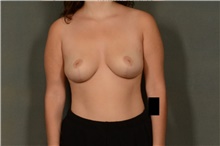 Breast Lift After Photo by Ellen Janetzke, MD; Bloomfield Hills, MI - Case 44716