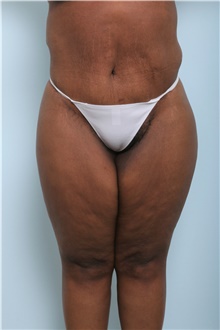 Body Lift After Photo by Paul Vitenas, Jr., MD; Houston, TX - Case 44872