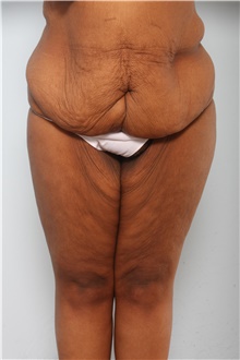Body Lift Before Photo by Paul Vitenas, Jr., MD; Houston, TX - Case 44872
