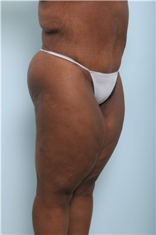 Body Lift After Photo by Paul Vitenas, Jr., MD; Houston, TX - Case 44872