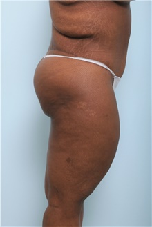 Body Lift After Photo by Paul Vitenas, Jr., MD; Houston, TX - Case 44872