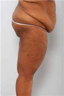 Body Lift Before Photo by Paul Vitenas, Jr., MD; Houston, TX - Case 44872
