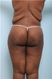 Body Lift After Photo by Paul Vitenas, Jr., MD; Houston, TX - Case 44872