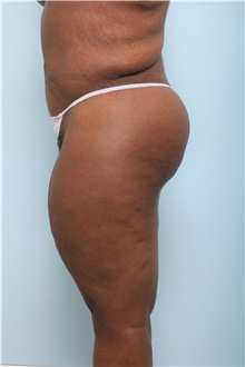 Body Lift After Photo by Paul Vitenas, Jr., MD; Houston, TX - Case 44872