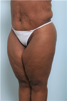 Body Lift After Photo by Paul Vitenas, Jr., MD; Houston, TX - Case 44872