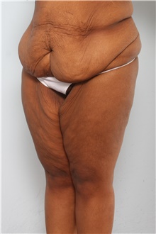 Body Lift Before Photo by Paul Vitenas, Jr., MD; Houston, TX - Case 44872