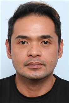 Chin Augmentation After Photo by Paul Vitenas, Jr., MD; Houston, TX - Case 44901