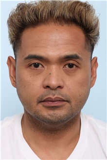 Chin Augmentation Before Photo by Paul Vitenas, Jr., MD; Houston, TX - Case 44901