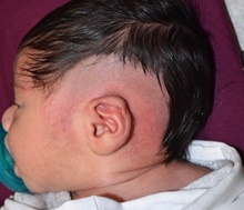 Ear Surgery Before Photo by Rachel Ruotolo, MD; Garden City, NY - Case 44972