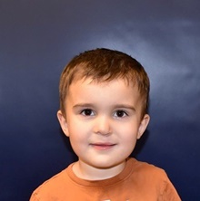 Cleft Lip and Palate Repair After Photo by Rachel Ruotolo, MD; Garden City, NY - Case 44979