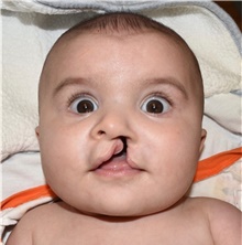 Cleft Lip and Palate Repair Before Photo by Rachel Ruotolo, MD; Garden City, NY - Case 44979