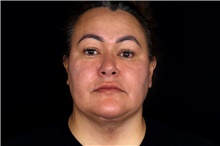 Facelift After Photo by Landon Pryor, MD, FACS; Rockford, IL - Case 45046