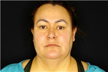 Facelift Before Photo by Landon Pryor, MD, FACS; Rockford, IL - Case 45046