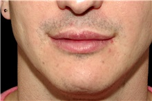 Lip Augmentation/Enhancement After Photo by Landon Pryor, MD, FACS; Rockford, IL - Case 45052