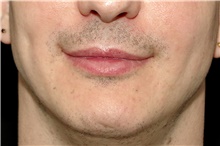 Lip Augmentation/Enhancement Before Photo by Landon Pryor, MD, FACS; Rockford, IL - Case 45052