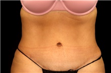 Tummy Tuck After Photo by Landon Pryor, MD, FACS; Rockford, IL - Case 45062