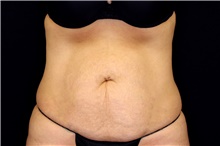 Tummy Tuck Before Photo by Landon Pryor, MD, FACS; Rockford, IL - Case 45062
