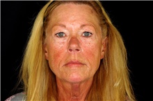 Brow Lift Before Photo by Landon Pryor, MD, FACS; Rockford, IL - Case 45064