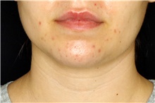 Liposuction After Photo by Landon Pryor, MD, FACS; Rockford, IL - Case 45110