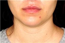 Liposuction Before Photo by Landon Pryor, MD, FACS; Rockford, IL - Case 45110