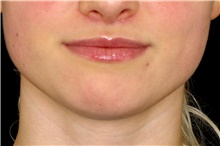 Lip Augmentation/Enhancement After Photo by Landon Pryor, MD, FACS; Rockford, IL - Case 45119