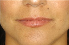 Lip Augmentation/Enhancement Before Photo by Landon Pryor, MD, FACS; Rockford, IL - Case 45136