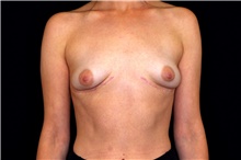 Breast Implant Removal After Photo by Landon Pryor, MD, FACS; Rockford, IL - Case 45179