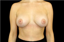 Breast Implant Removal Before Photo by Landon Pryor, MD, FACS; Rockford, IL - Case 45179