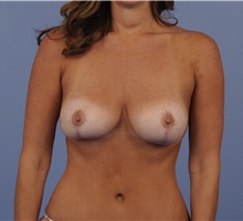 Mommy Makeover After Photo by Katerina Gallus, MD, FACS; San Diego, CA - Case 45276