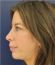 Rhinoplasty After Photo by Richard Reish, MD, FACS; New York, NY - Case 45326