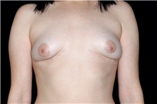 Breast Implant Removal After Photo by Landon Pryor, MD, FACS; Rockford, IL - Case 45669