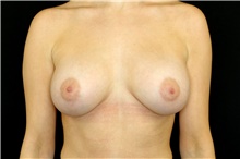 Breast Implant Removal Before Photo by Landon Pryor, MD, FACS; Rockford, IL - Case 45669