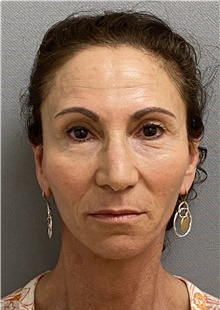 Facelift After Photo by Keshav Magge, MD; Bethesda, MD - Case 46013