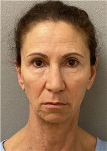 Facelift Before Photo by Keshav Magge, MD; Bethesda, MD - Case 46013