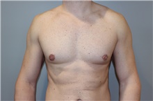 Male Breast Reduction After Photo by Ellen Mahony, MD; Westport, CT - Case 46041